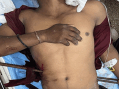 25 वर्षीय युवा के शरीर में 12 एमएम के 3 लोहे के सरिए निकालने की जटिल सर्जरी एमवाय में सफल