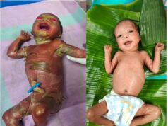 सुदूर बीजापुर में चिकित्सा चमत्कार : अत्यंत दुर्लभ बीमारी से जूझते शिशु को बचाया….